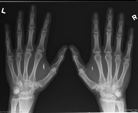 A practical guide to microchip implants 